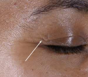72k-eye-cream-women-correction-wrinkles-day0-before