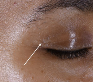 72k-eye-cream-women-correction-wrinkles-day56-after