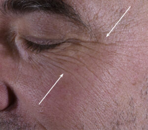 72k-eye-serum-men-correction-wrinkles-day0-before