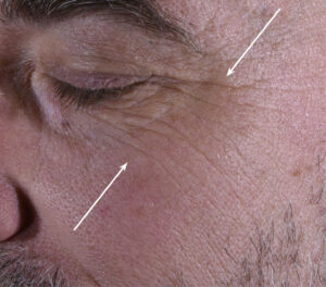 72k-eye-serum-men-correction-wrinkles-day56-after