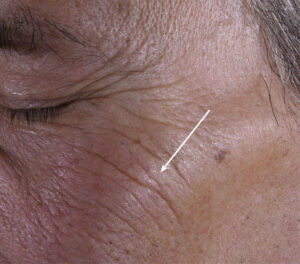72k-face-serum-men-correction-wrinkles-day0-before
