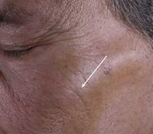 72k-face-serum-men-correction-wrinkles-day56-after