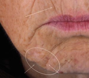 72k-face-serum-women-skin-lifting-correction-wrinkles-day0-before