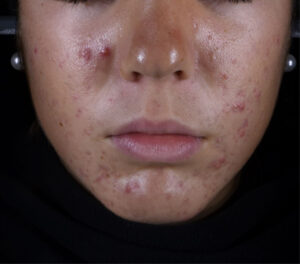 72k-multi-spot-serum-acne-prone-skin-day0-before