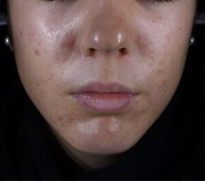 72k-multi-spot-serum-acne-prone-skin-day56-after